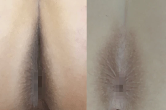 Before and After Anal Bleaching Does It Really Work
