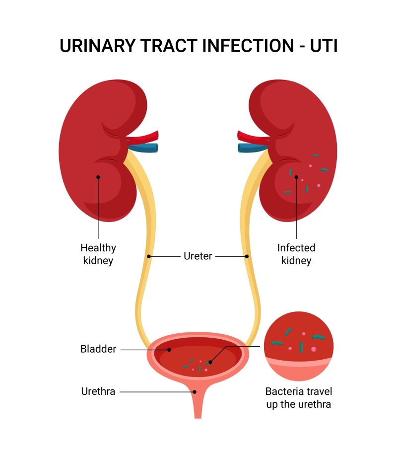 Do I Have a UTI or STD Take the Quiz to Find Out Now